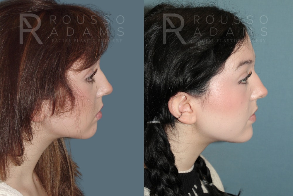 Facial Implants <span class=small>By Dr. Daniel Rousso</span> Before & After Gallery - Patient 149283992 - Image 2