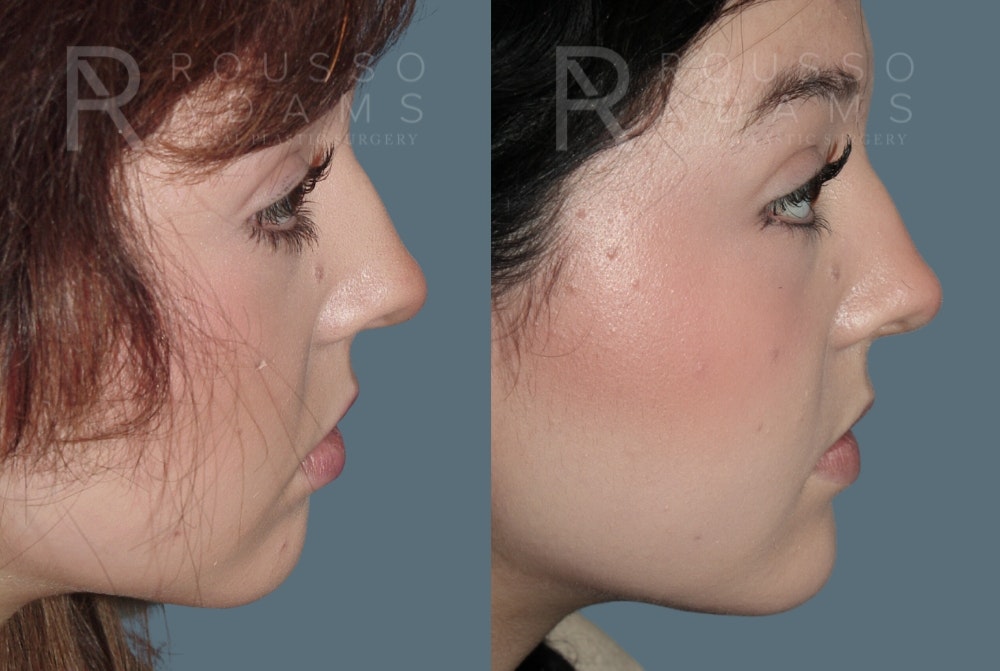Facial Implants <span class=small>By Dr. Daniel Rousso</span> Before & After Gallery - Patient 149283992 - Image 3