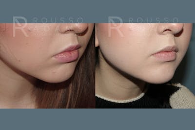 Facial Implants <span class=small>By Dr. Daniel Rousso</span> Before & After Gallery - Patient 149283992 - Image 4