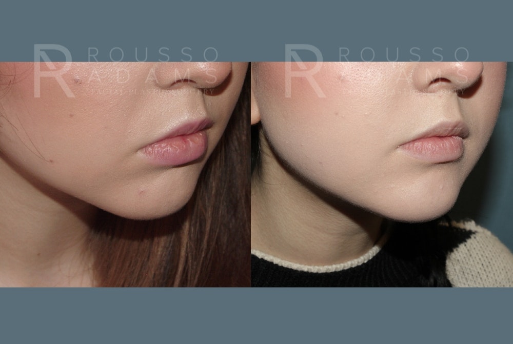 Facial Implants <span class=small>By Dr. Daniel Rousso</span> Before & After Gallery - Patient 149283992 - Image 4