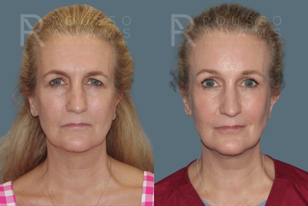 Blepharoplasty Before & After Gallery - Patient 403856 - Image 3