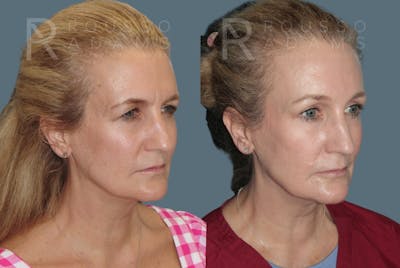 Blepharoplasty Before & After Gallery - Patient 403856 - Image 4