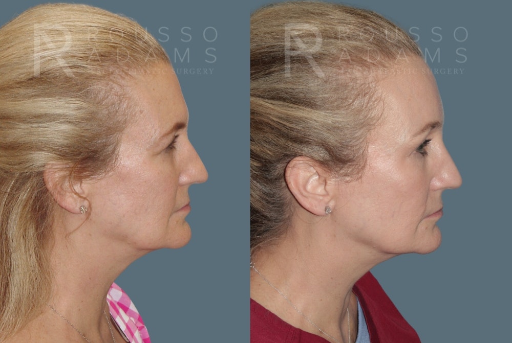 Blepharoplasty Before & After Gallery - Patient 403856 - Image 5