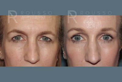 Blepharoplasty<span class=small>By Dr. Austin Adams</span> Before & After Gallery - Patient 403856 - Image 1