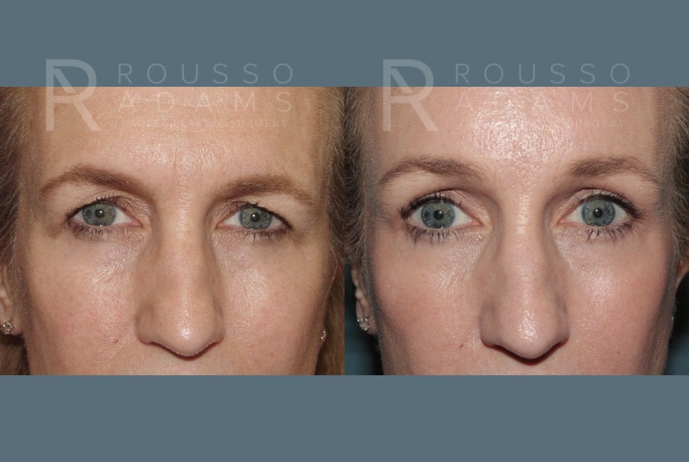 Blepharoplasty Before & After Gallery - Patient 149284011 - Image 1