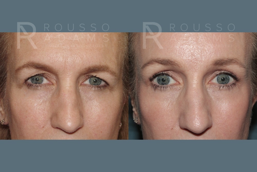 Blepharoplasty<span class=small>By Dr. Austin Adams</span> Before & After Gallery - Patient 403856 - Image 1