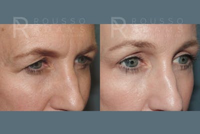 Blepharoplasty<span class=small>By Dr. Austin Adams</span> Before & After Gallery - Patient 403856 - Image 2