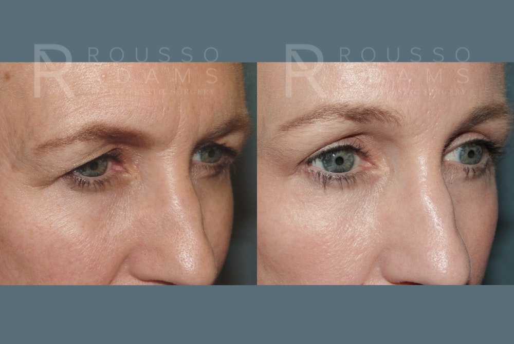 Blepharoplasty Before & After Gallery - Patient 403856 - Image 2