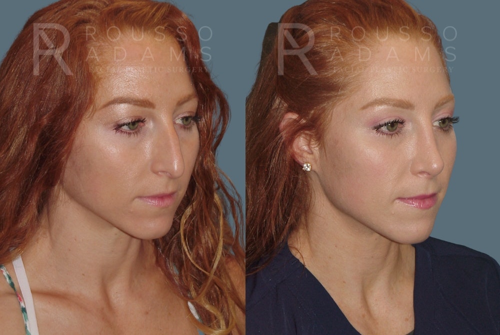 Rhinoplasty <span class=small>By Dr. Daniel Rousso</span> Before & After Gallery - Patient 149283998 - Image 3