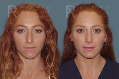 Rhinoplasty <span class=small>By Dr. Daniel Rousso</span> Before & After Gallery - Patient 149283998 - Image 2