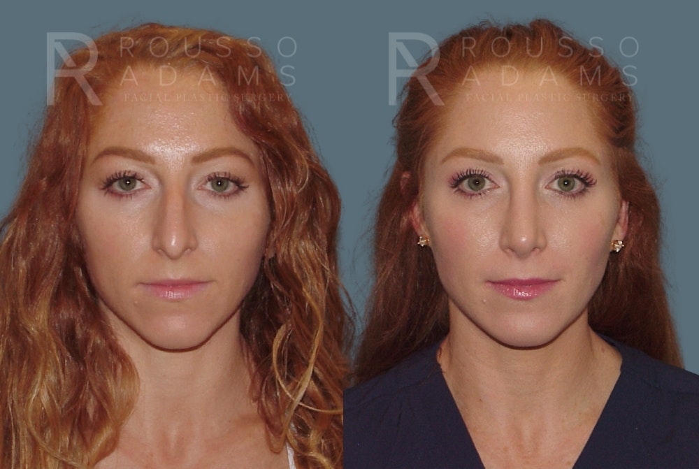 Rhinoplasty Before & After Gallery - Patient 149283998 - Image 2