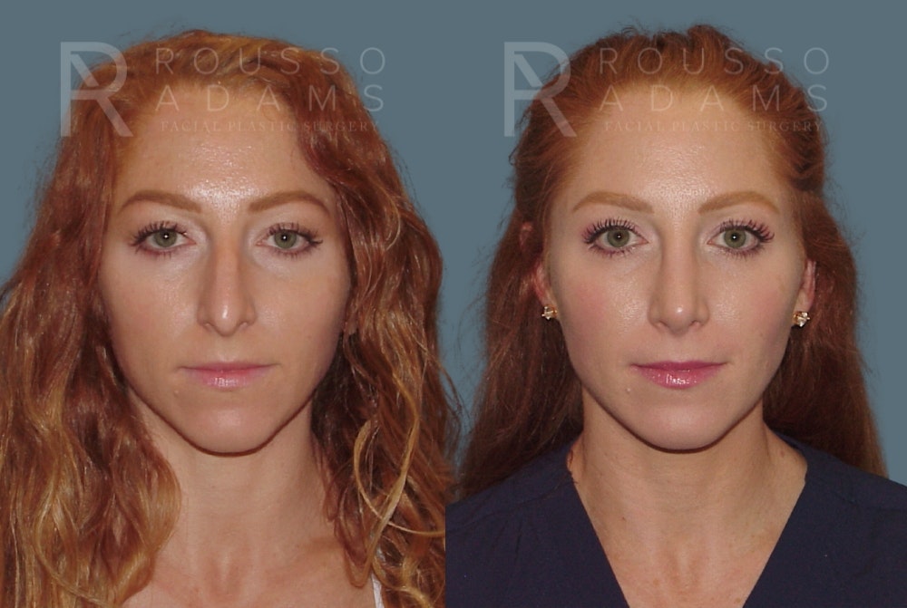 Rhinoplasty <span class=small>By Dr. Daniel Rousso</span> Before & After Gallery - Patient 149283998 - Image 2