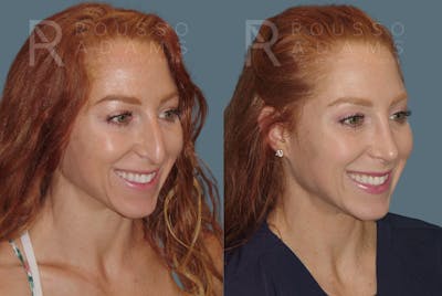 Rhinoplasty <span class=small>By Dr. Daniel Rousso</span> Before & After Gallery - Patient 149283998 - Image 4