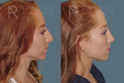 Rhinoplasty <span class=small>By Dr. Daniel Rousso</span> Before & After Gallery - Patient 149283998 - Image 1
