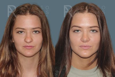 Rhinoplasty <span class=small>By Dr. Daniel Rousso</span> Before & After Gallery - Patient 149284000 - Image 2