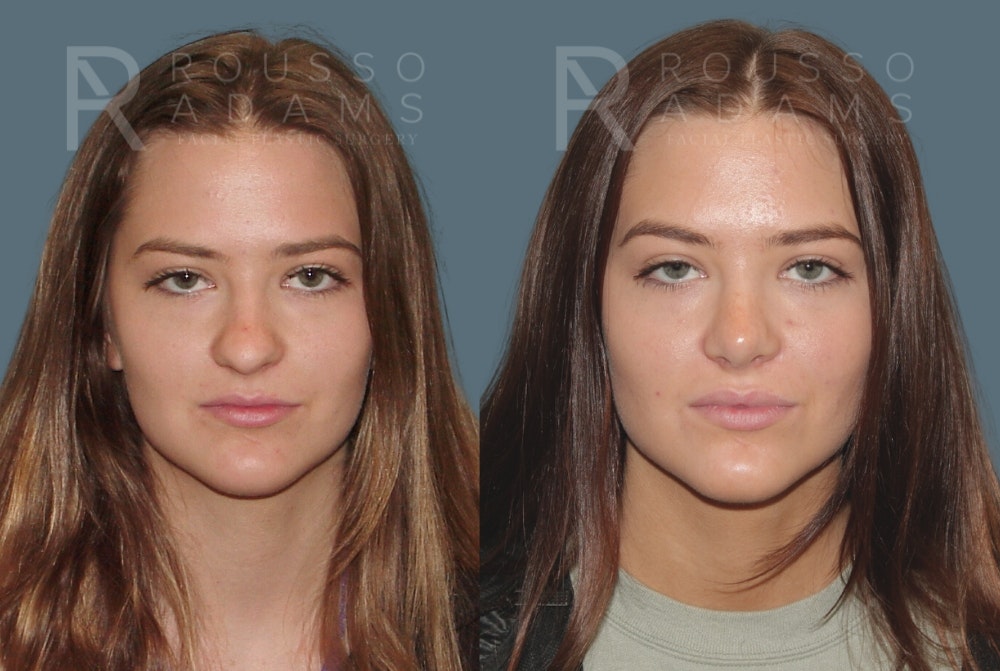 Rhinoplasty <span class=small>By Dr. Daniel Rousso</span> Before & After Gallery - Patient 149284000 - Image 2