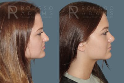 Rhinoplasty <span class=small>By Dr. Daniel Rousso</span> Before & After Gallery - Patient 149284000 - Image 1