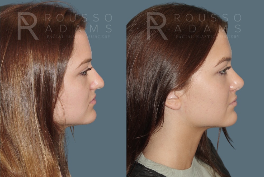 Rhinoplasty <span class=small>By Dr. Daniel Rousso</span> Before & After Gallery - Patient 149284000 - Image 1