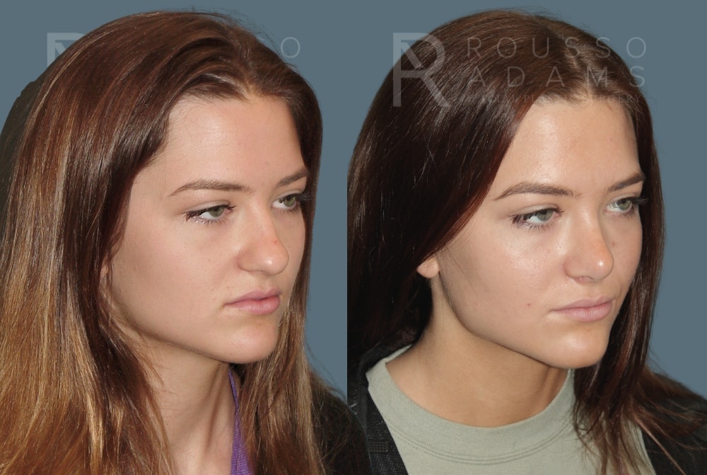 Rhinoplasty <span class=small>By Dr. Daniel Rousso</span> Before & After Gallery - Patient 149284000 - Image 3