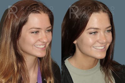 Rhinoplasty <span class=small>By Dr. Daniel Rousso</span> Before & After Gallery - Patient 149284000 - Image 4