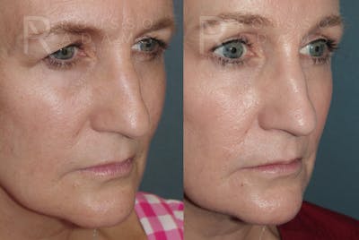 Skin Rejuvenation<span class=small>By Dr. Austin Adams</span> Before & After Gallery - Patient 278716 - Image 1