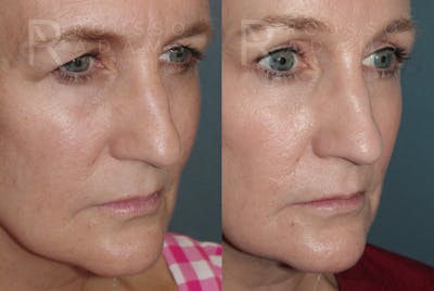 Skin Rejuvenation Before & After Gallery - Patient 278716 - Image 1