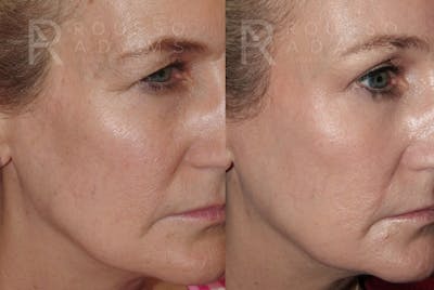 Skin Rejuvenation Before & After Gallery - Patient 278716 - Image 2