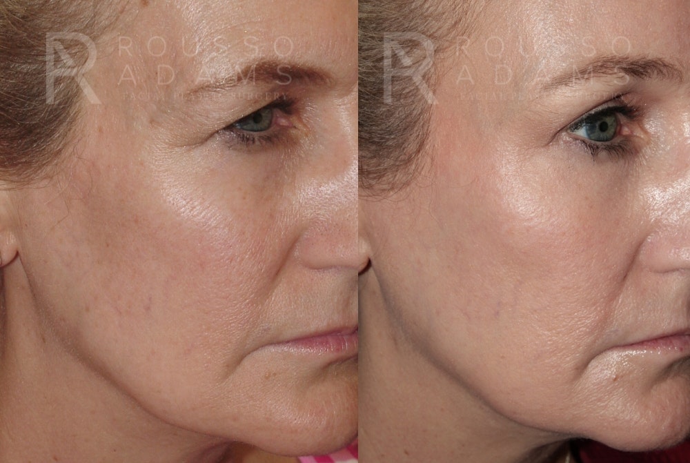 Skin Rejuvenation<span class=small>By Dr. Austin Adams</span> Before & After Gallery - Patient 278716 - Image 2