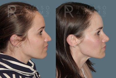 Rhinoplasty <span class=small>By Dr. Daniel Rousso</span> Before & After Gallery - Patient 157603009 - Image 1