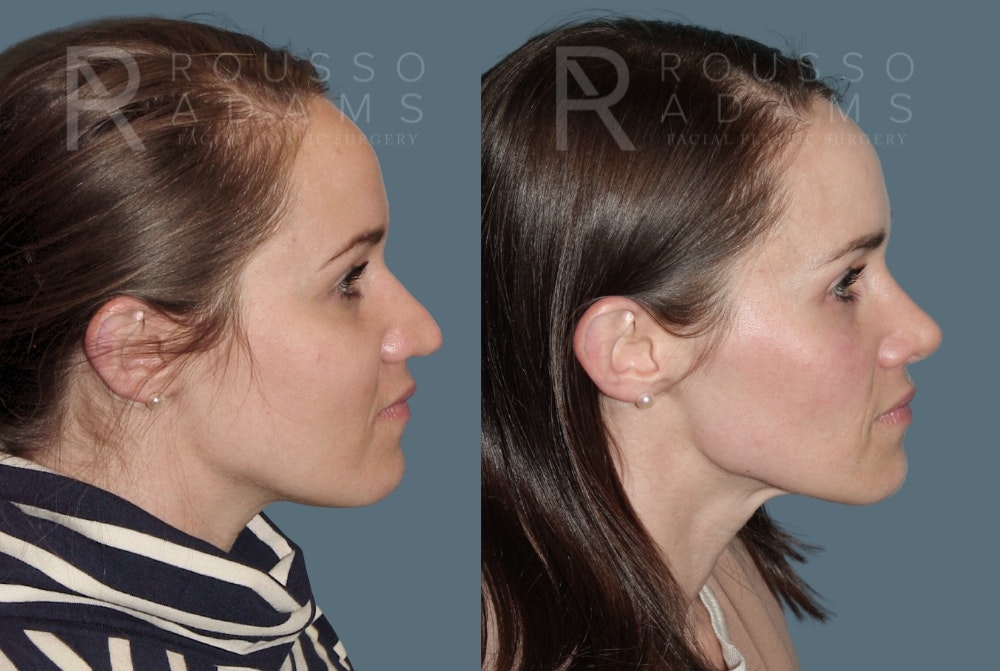 Rhinoplasty <span class=small>By Dr. Daniel Rousso</span> Before & After Gallery - Patient 157603009 - Image 1