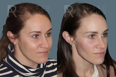 Rhinoplasty <span class=small>By Dr. Daniel Rousso</span> Before & After Gallery - Patient 157603009 - Image 2