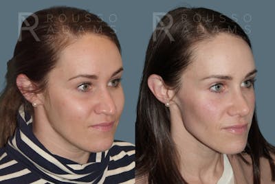 Rhinoplasty Before & After Gallery - Patient 157603009 - Image 2