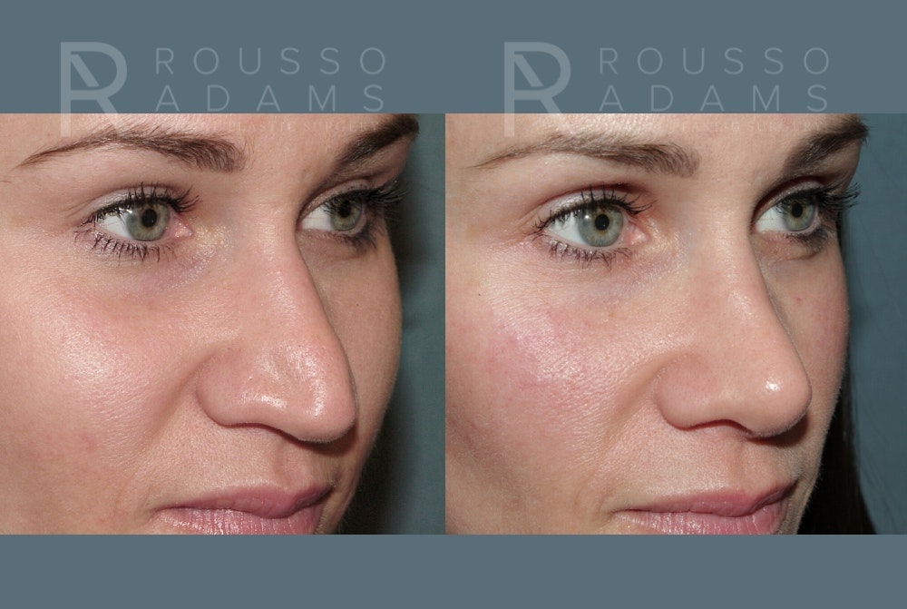 Rhinoplasty Before & After Gallery - Patient 157603009 - Image 3