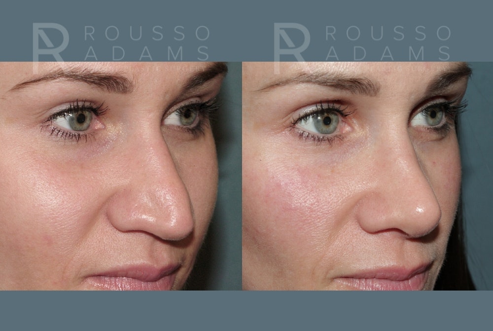 Rhinoplasty <span class=small>By Dr. Daniel Rousso</span> Before & After Gallery - Patient 157603009 - Image 3