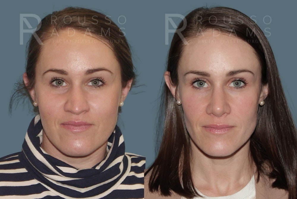 Rhinoplasty Before & After Gallery - Patient 157603009 - Image 4