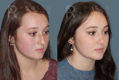 Rhinoplasty <span class=small>By Dr. Daniel Rousso</span> Before & After Gallery - Patient 157603012 - Image 2