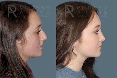 Rhinoplasty Before & After Gallery - Patient 157603012 - Image 1