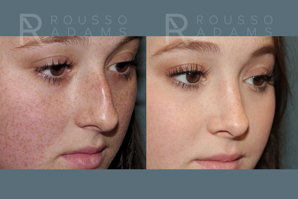 Rhinoplasty Before & After Gallery - Patient 157603012 - Image 3