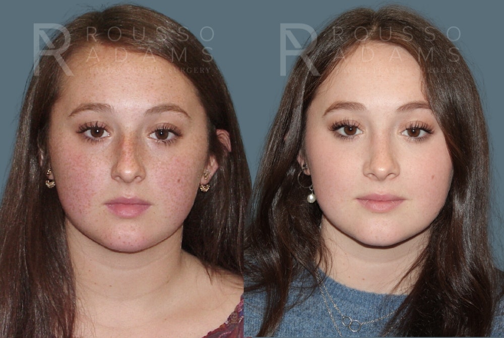 Rhinoplasty Before & After Gallery - Patient 157603012 - Image 4