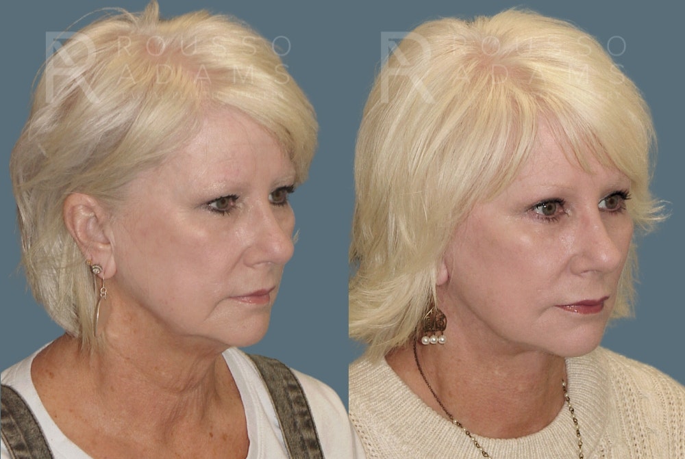 Blepharoplasty Before & After Gallery - Patient 157603015 - Image 5