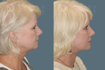 Blepharoplasty <span class=small>By Dr. Daniel Rousso</span> Before & After Gallery - Patient 157603015 - Image 6