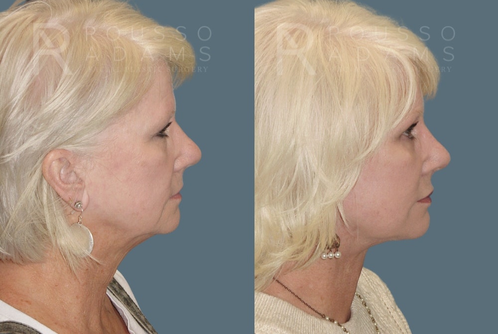 Facelift Before & After Gallery - Patient 157603014 - Image 3