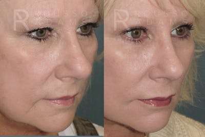 SculptLift™ <span class=small>By Dr. Daniel Rousso</span> Before & After Gallery - Patient 157603013 - Image 4