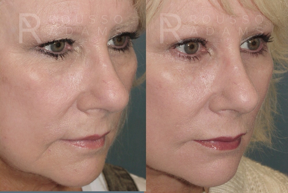 Blepharoplasty <span class=small>By Dr. Daniel Rousso</span> Before & After Gallery - Patient 157603015 - Image 3