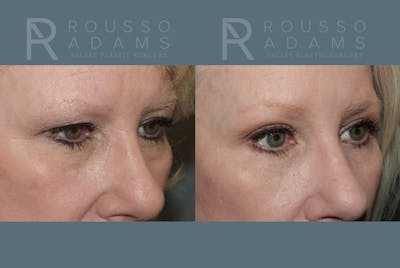 Blepharoplasty <span class=small>By Dr. Daniel Rousso</span> Before & After Gallery - Patient 157603015 - Image 2