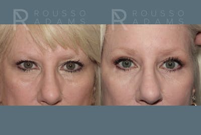 Blepharoplasty <span class=small>By Dr. Daniel Rousso</span> Before & After Gallery - Patient 157603015 - Image 1