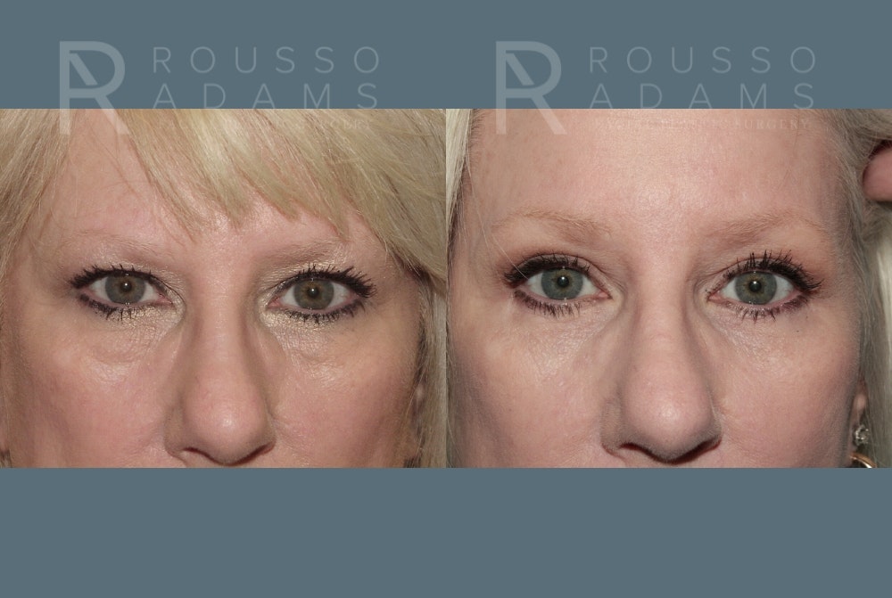 Blepharoplasty <span class=small>By Dr. Daniel Rousso</span> Before & After Gallery - Patient 157603015 - Image 1