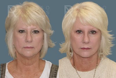 Facelift Before & After Gallery - Patient 157603014 - Image 2