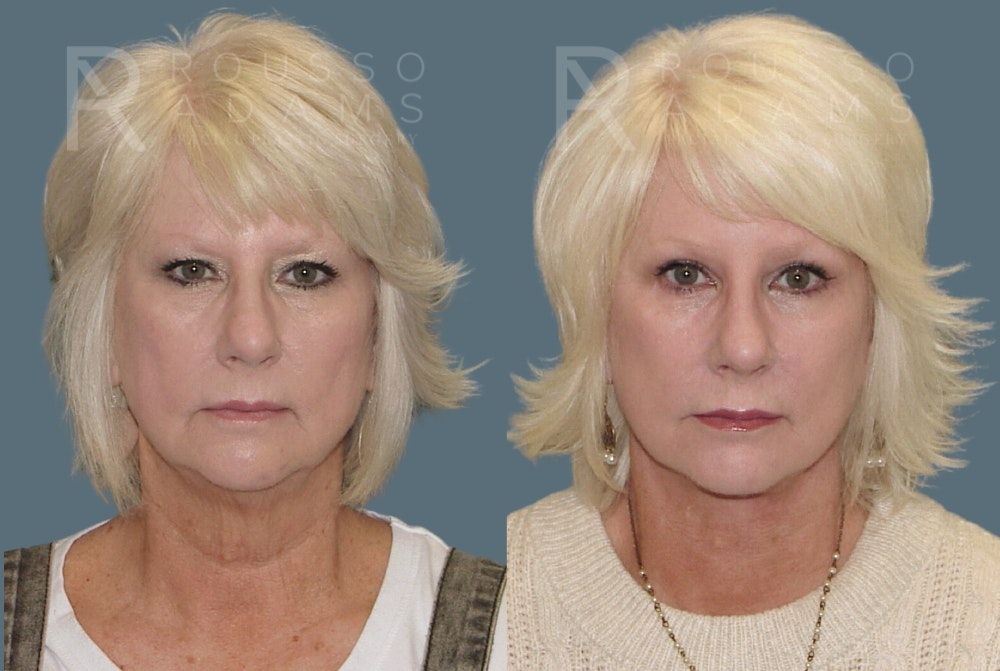 Facelift Before & After Gallery - Patient 157603014 - Image 2