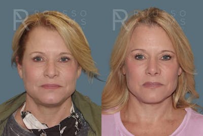Rhinoplasty <span class=small>By Dr. Daniel Rousso</span> Before & After Gallery - Patient 160572931 - Image 4